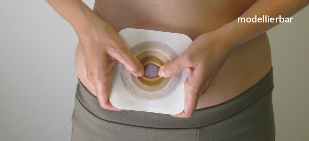 ConvaTec Esteem Synergy Versorgungswechsel Schritt f&uuml;r Schritt 03