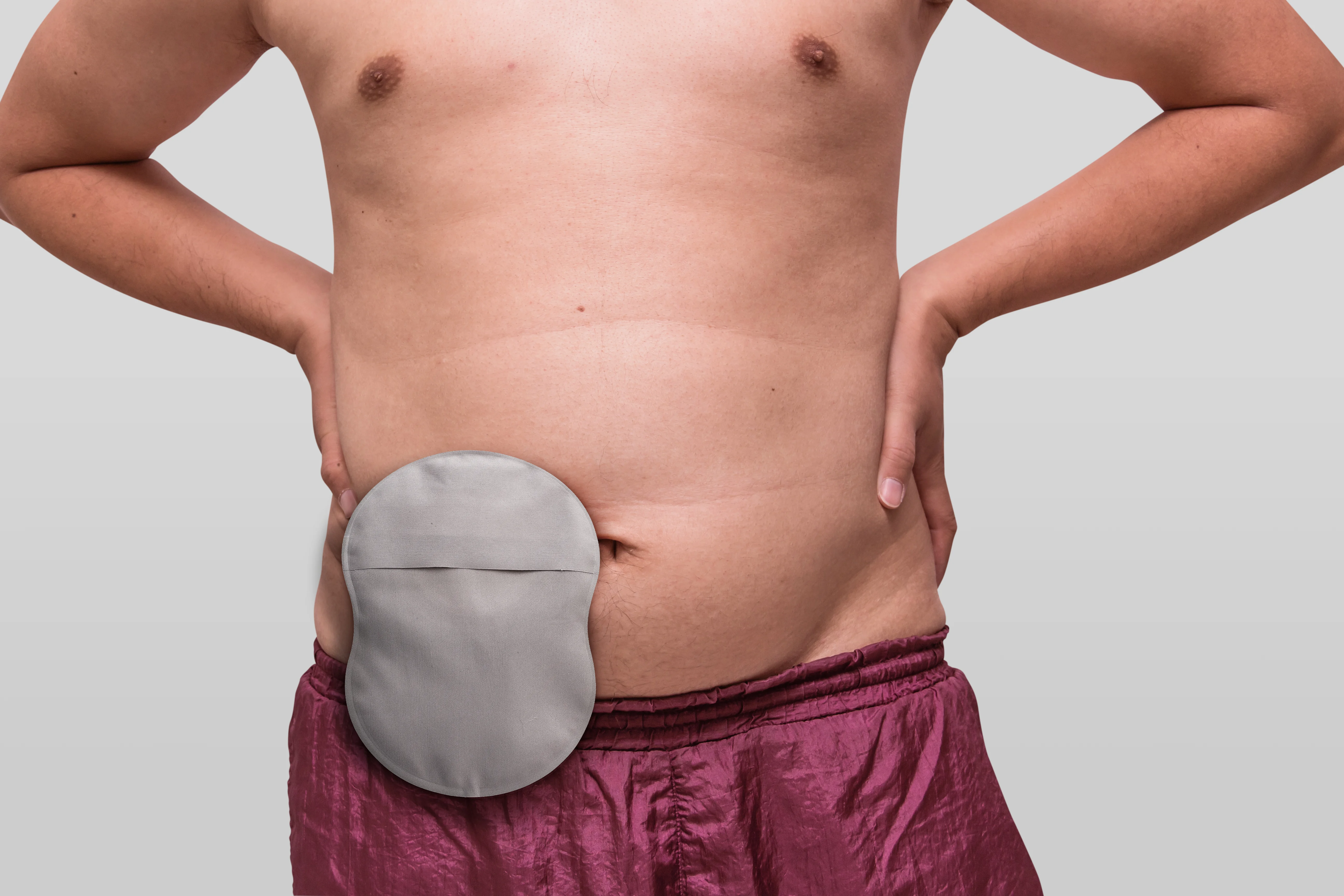 Man with an ostomy showing his pouch