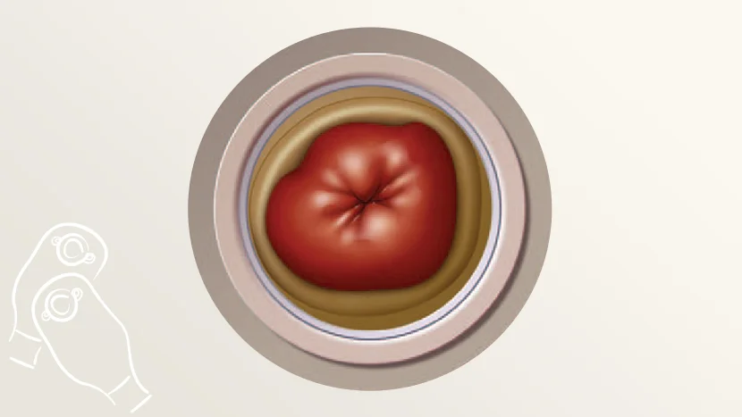 a drawing of a stoma