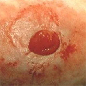 造口周圍皮膚受刺激