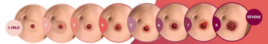 造口周圍皮膚問題的階段。