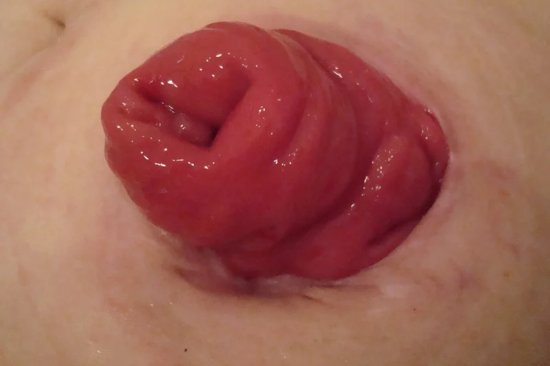 Stomia prawidłowa z uwypukloną śluz&oacute;wką