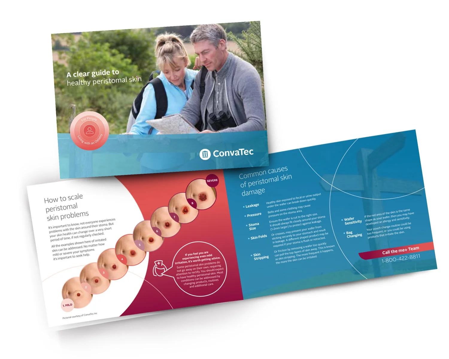 摺頁冊的封面：「健康造口周圍皮膚清晰指南」深入探討了鱗屑問題和皮膚損傷的常見原因。